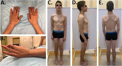 Case Report: New phenotype of late-onset Stüve–Wiedemann syndrome due to a C-terminal variant in the LIFR gene